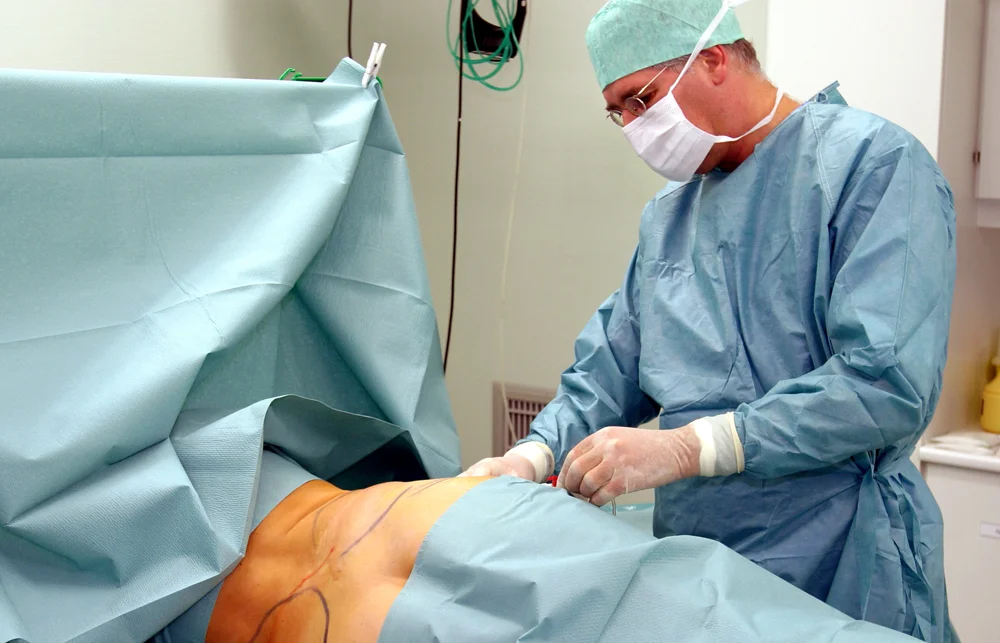 tumescente vibro-liposuctie