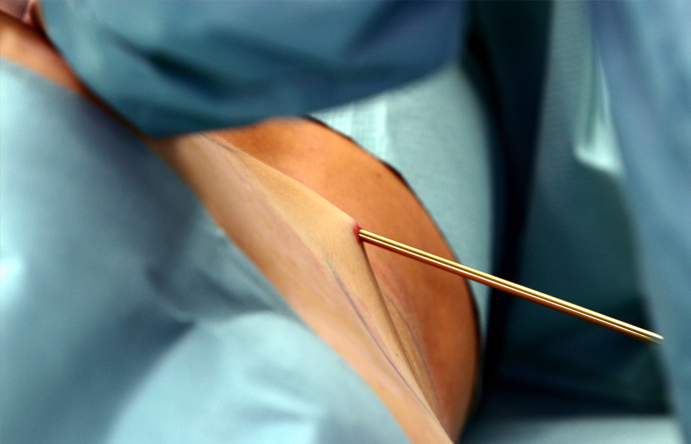 LIPLEG-studie liposuctie lipoedeem