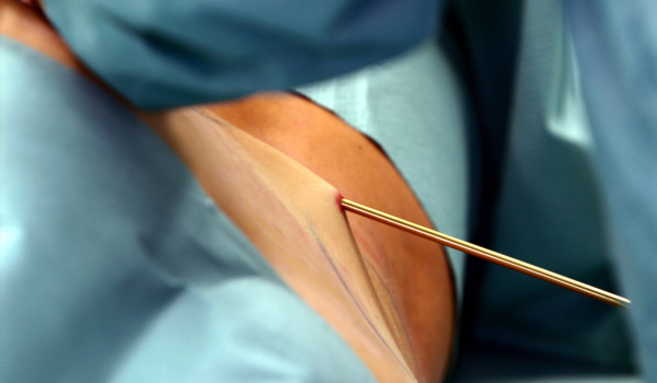 De LIPLEG-studie bevestigt het belang van liposuctie bij lipoedeem