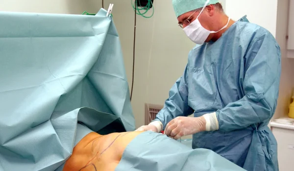 Wat is de beste techniek voor liposuctie?
